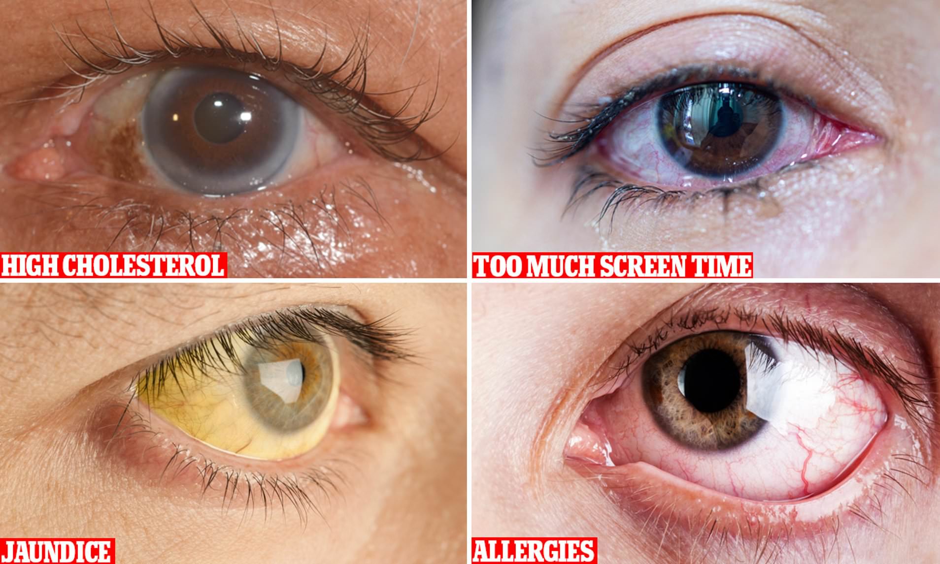 Eye health
